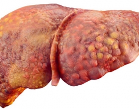 Men gan tăng nhẹ có nên đi khám không thưa bác sĩ